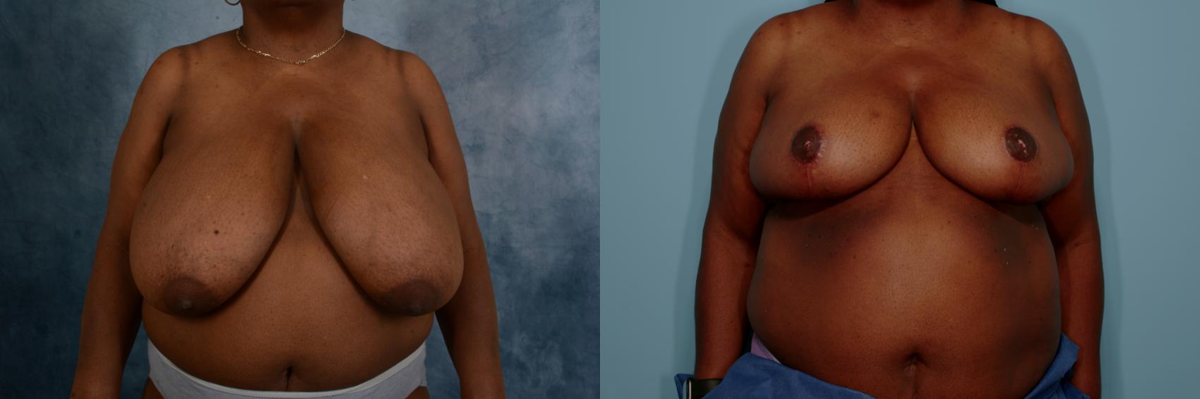 Before & After Breast Reduction Case 677 Front View in Tallahassee, FL