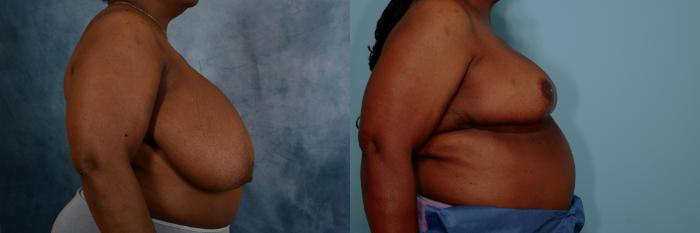 Before & After Breast Reduction Case 677 Right Side View in Tallahassee, FL