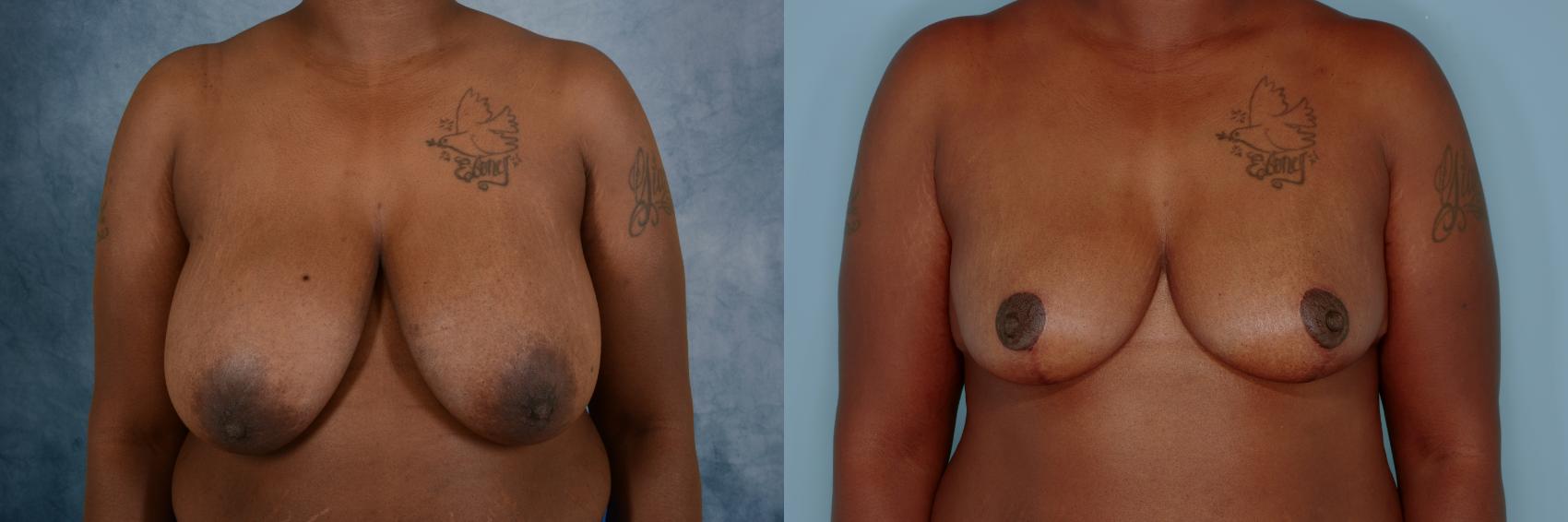 Before & After Breast Reduction Case 697 Front View in Tallahassee, FL