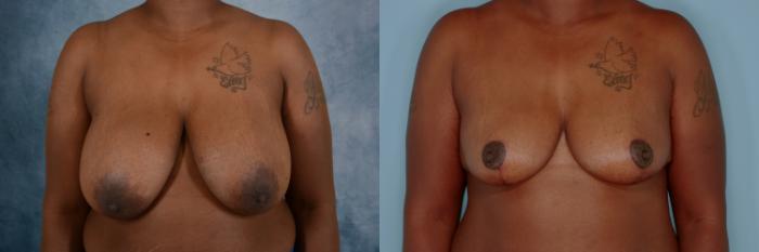 Before & After Breast Reduction Case 697 Front View in Tallahassee, FL