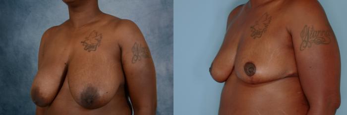 Before & After Breast Reduction Case 697 Left Oblique View in Tallahassee, FL