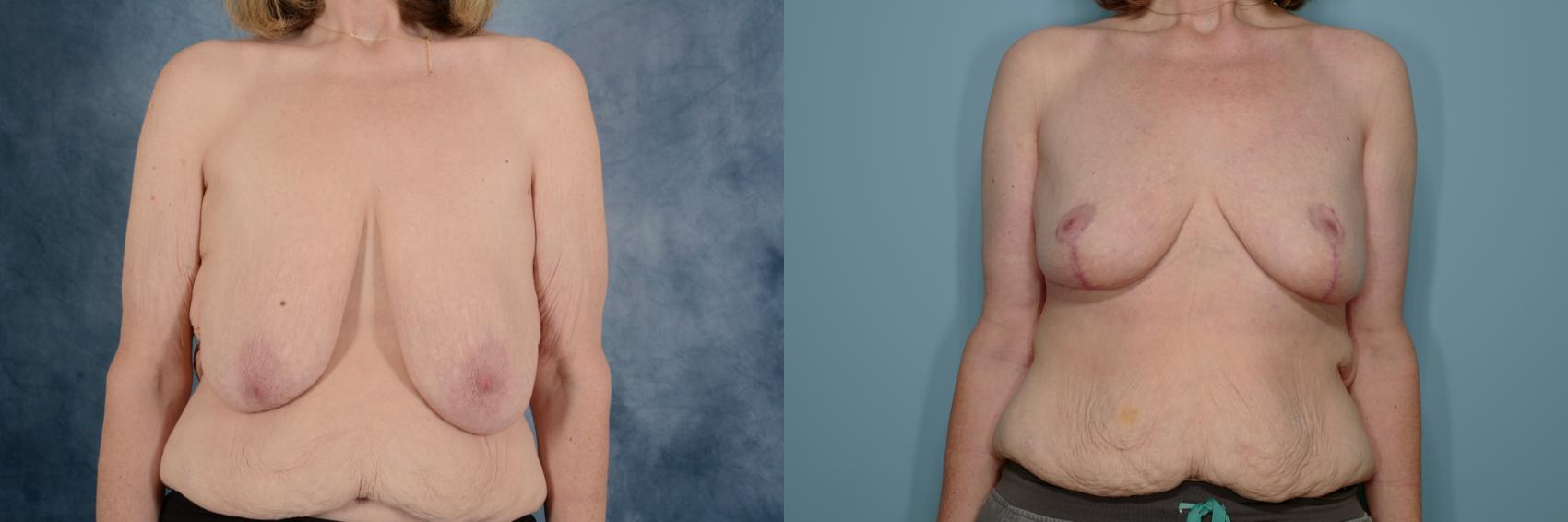 Before & After Breast Reduction Case 712 Front View in Tallahassee, FL