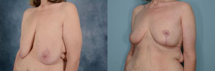 Before & After Breast Reduction Case 712 Left Oblique View in Tallahassee, FL