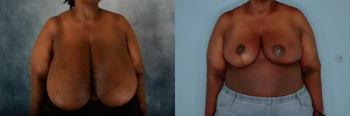 Before & After Breast Reduction Case 726 Front View in Tallahassee, FL