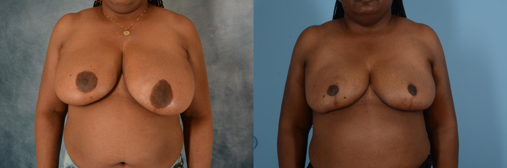 Before & After Breast Reduction Case 743 Front View in Tallahassee, FL