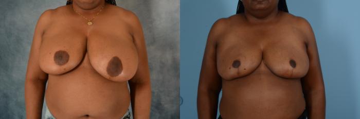 Before & After Breast Reduction Case 743 Front View in Tallahassee, FL