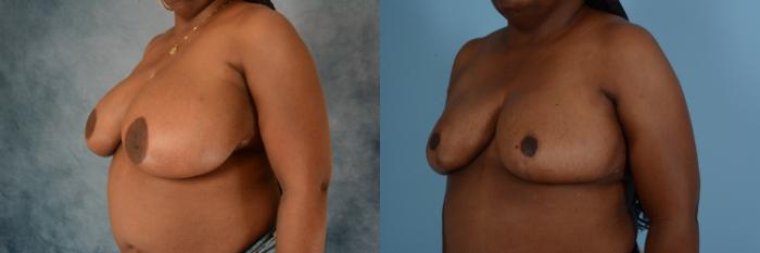 Before & After Breast Reduction Case 743 Left Side View in Tallahassee, FL