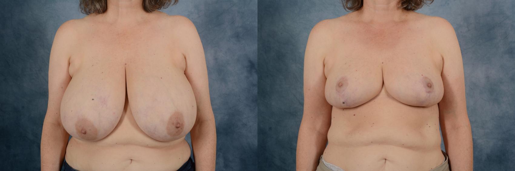 Before & After Breast Reduction Case 750 Front View in Tallahassee, FL