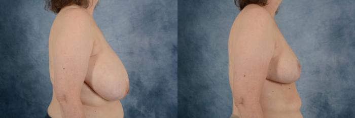 Before & After Breast Reduction Case 750 Right Side View in Tallahassee, FL