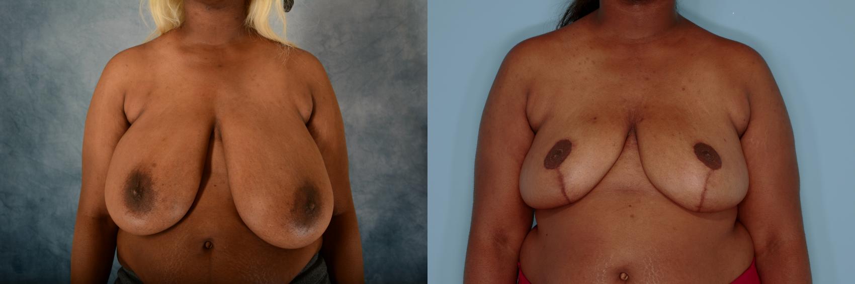 Before & After Breast Reduction Case 755 Front View in Tallahassee, FL