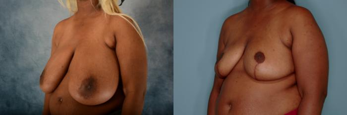 Before & After Breast Reduction Case 755 Left Oblique View in Tallahassee, FL