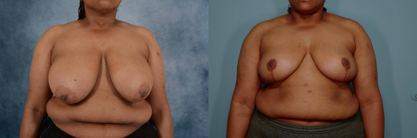 Before & After Breast Reduction Case 756 Front View in Tallahassee, FL