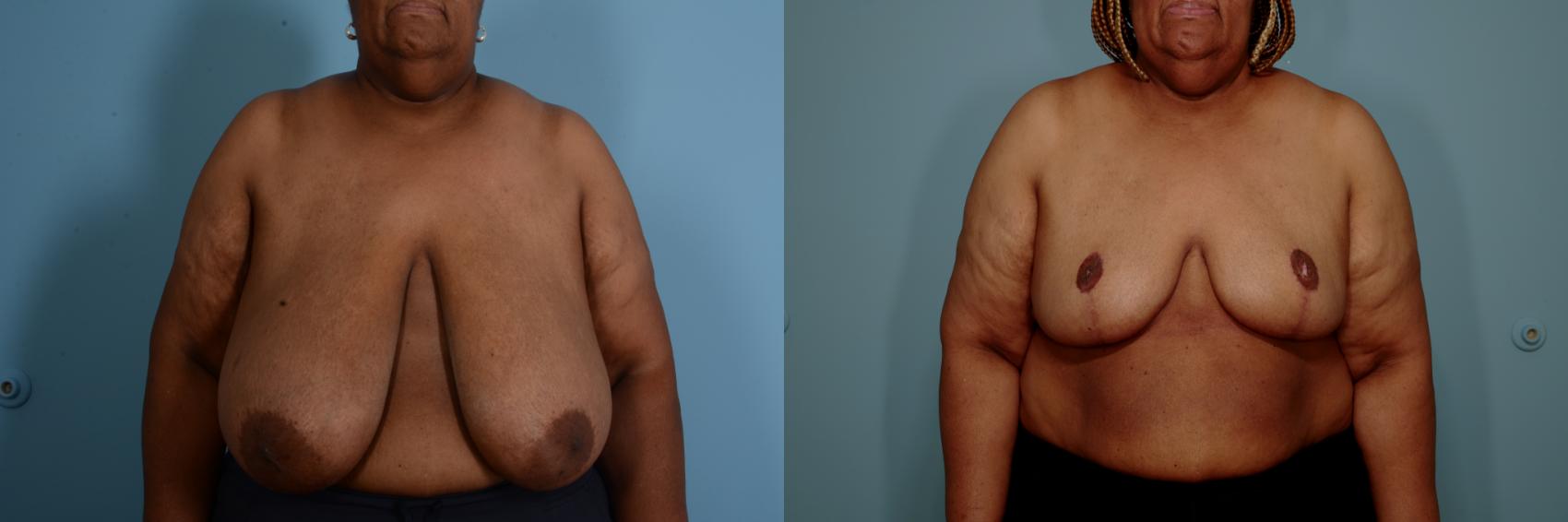 Before & After Breast Reduction Case 762 Front View in Tallahassee, FL