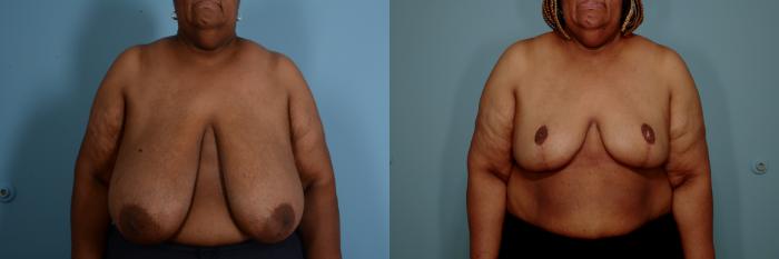 Before & After Breast Reduction Case 762 Front View in Tallahassee, FL