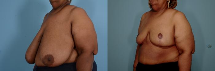 Before & After Breast Reduction Case 762 Left Side View in Tallahassee, FL