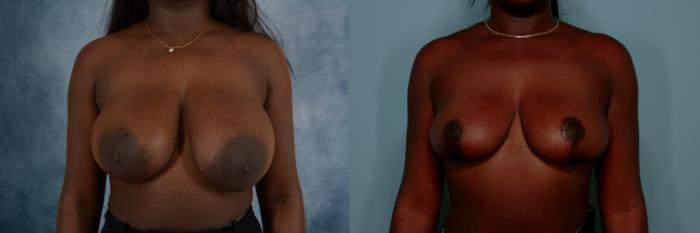 Before & After Breast Reduction Case 763 Front View in Tallahassee, FL