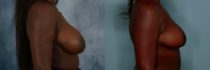 Before & After Breast Reduction Case 763 Right Side View in Tallahassee, FL