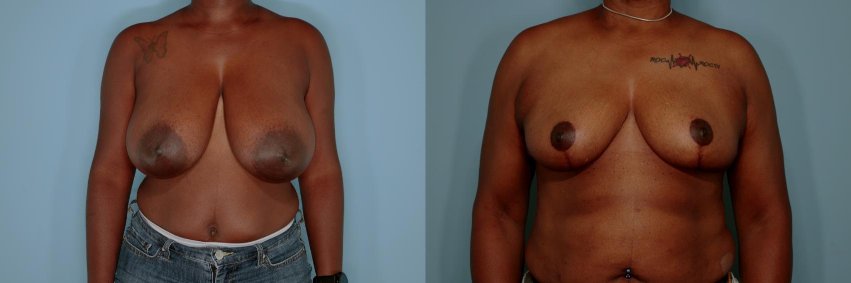 Before & After Breast Reduction Case 767 Front View in Tallahassee, FL
