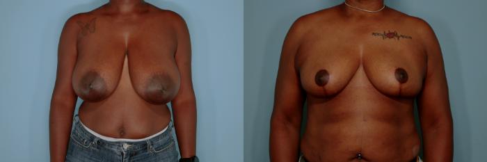 Before & After Breast Reduction Case 767 Front View in Tallahassee, FL