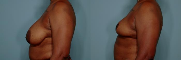 Before & After Breast Reduction Case 767 Left Side View in Tallahassee, FL