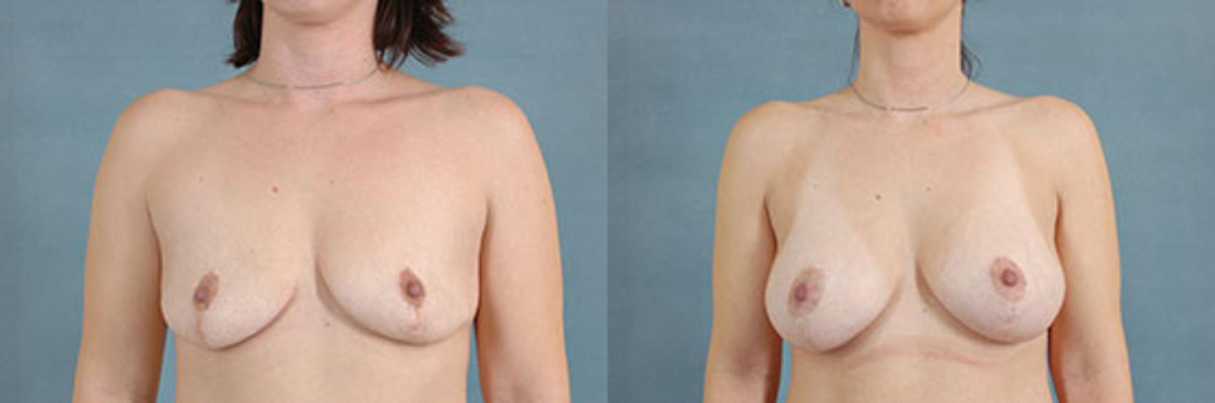 Before & After Breast Revision Surgery Case 233 View #1 View in Tallahassee, FL