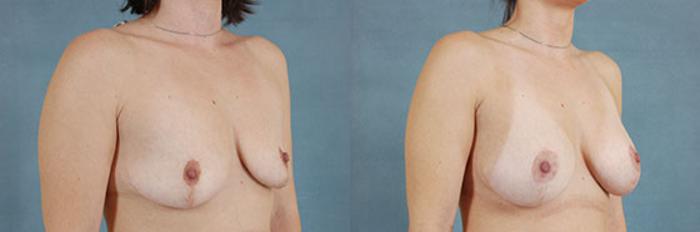 Before & After Breast Revision Surgery Case 233 View #2 View in Tallahassee, FL