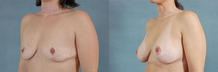 Before & After Breast Revision Surgery Case 233 View #3 View in Tallahassee, FL