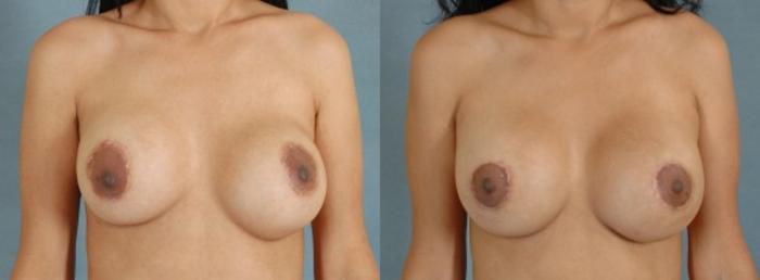 Before & After Breast Revision Surgery Case 235 View #1 View in Tallahassee, FL