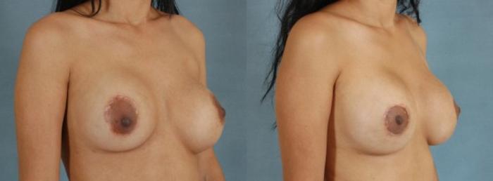 Before & After Breast Revision Surgery Case 235 View #2 View in Tallahassee, FL