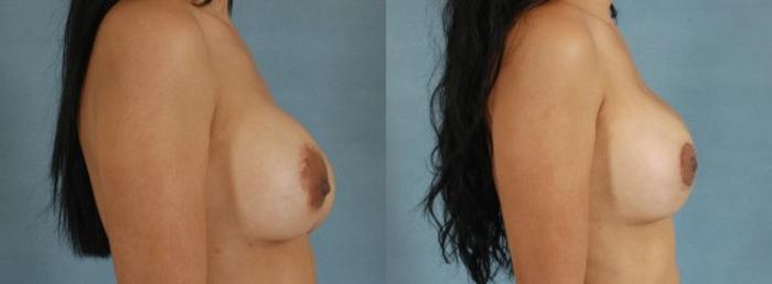 Before & After Breast Revision Surgery Case 235 View #3 View in Tallahassee, FL