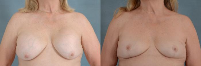 Before & After Breast Revision Surgery Case 236 View #1 View in Tallahassee, FL