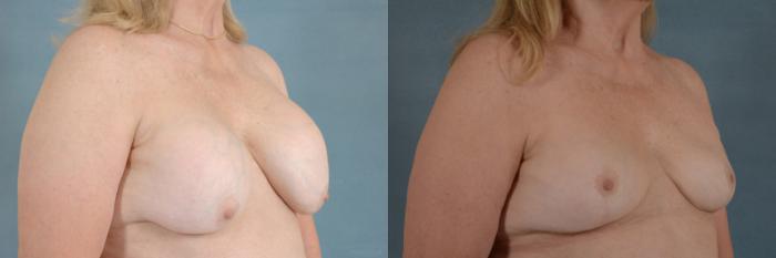 Before & After Breast Revision Surgery Case 236 View #2 View in Tallahassee, FL