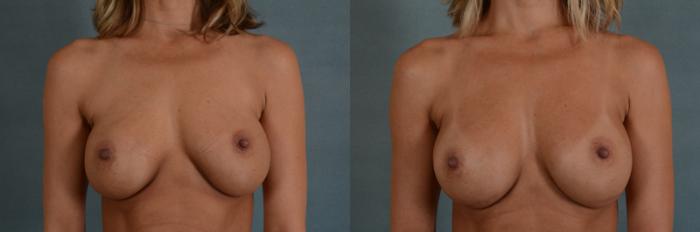 Before & After Breast Revision Surgery Case 237 View #1 View in Tallahassee, FL