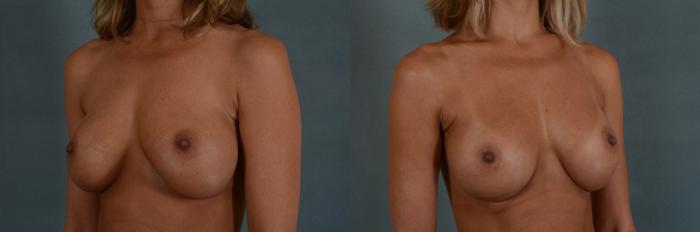 Before & After Breast Revision Surgery Case 237 View #2 View in Tallahassee, FL