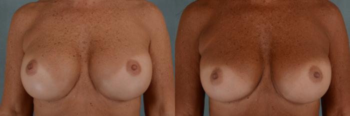Before & After Breast Revision Surgery Case 298 View #1 View in Tallahassee, FL