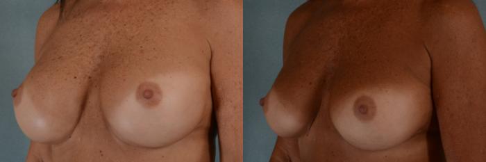 Before & After Breast Revision Surgery Case 298 View #2 View in Tallahassee, FL