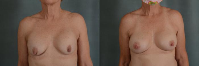Before & After Breast Revision Surgery Case 326 View #1 View in Tallahassee, FL