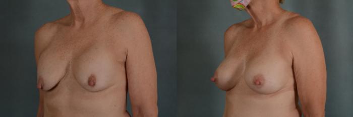 Before & After Breast Revision Surgery Case 326 View #2 View in Tallahassee, FL