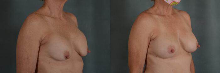 Before & After Breast Revision Surgery Case 326 View #3 View in Tallahassee, FL