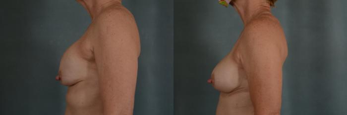 Before & After Breast Revision Surgery Case 326 View #4 View in Tallahassee, FL