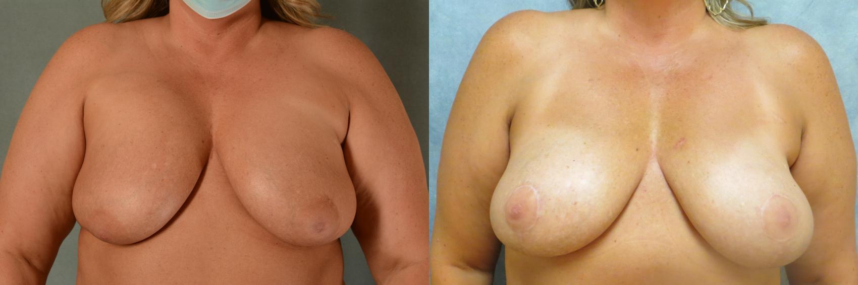 Before & After Breast Revision Surgery Case 489 Front View in Tallahassee, FL