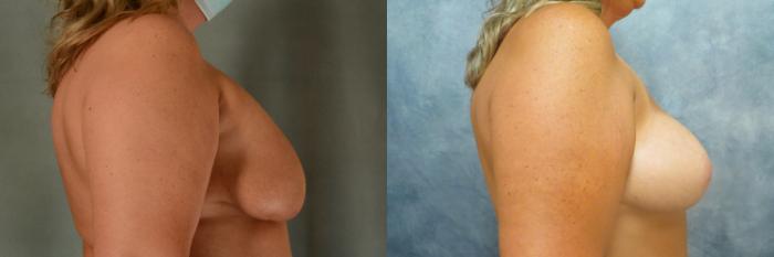 Before & After Breast Revision Surgery Case 489 Right Oblique View in Tallahassee, FL