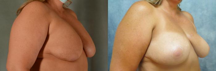 Before & After Breast Revision Surgery Case 489 Right Side View in Tallahassee, FL