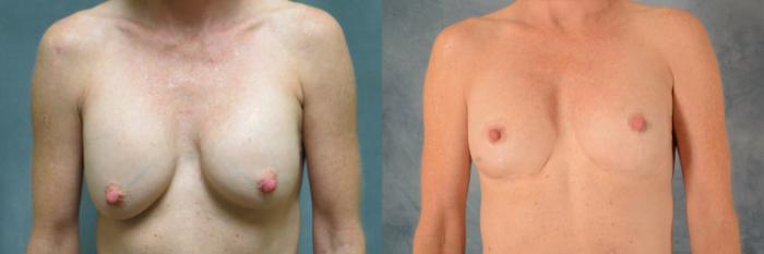 Before & After Breast Revision Surgery Case 506 Front View in Tallahassee, FL
