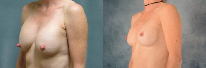 Before & After Breast Revision Surgery Case 506 Left Oblique View in Tallahassee, FL