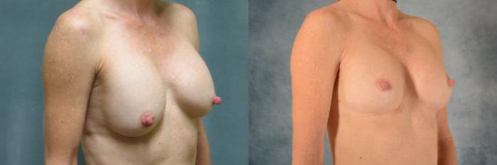 Before & After Breast Revision Surgery Case 506 Right Oblique View in Tallahassee, FL