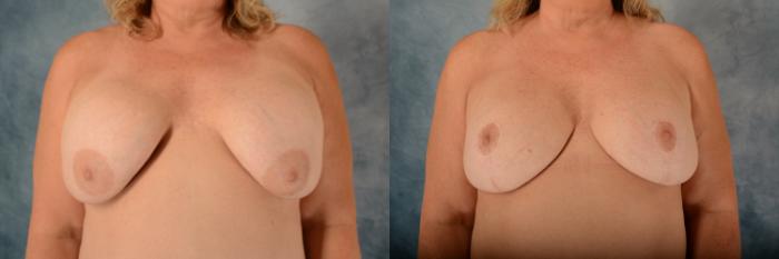 Before & After Breast Revision Surgery Case 616 Front View in Tallahassee, FL