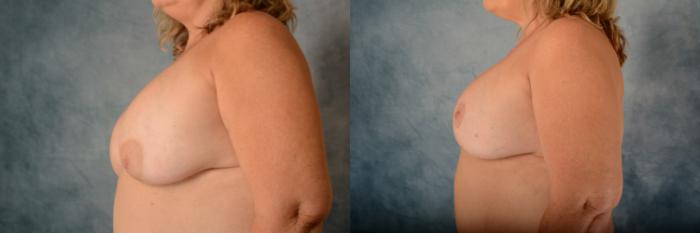 Before & After Breast Revision Surgery Case 616 Left Side View in Tallahassee, FL