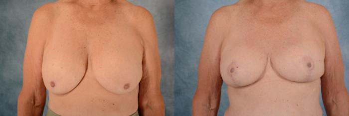 Before & After Breast Revision Surgery Case 698 Front View in Tallahassee, FL
