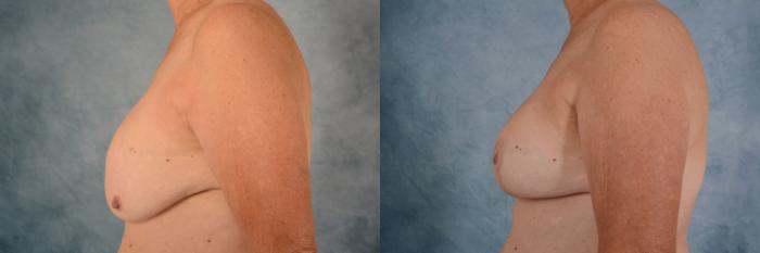 Before & After Breast Revision Surgery Case 698 Left Side View in Tallahassee, FL